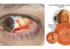 Blood Clot in Eye: When Is It Harmless and When Could It Be an Eye Stroke?