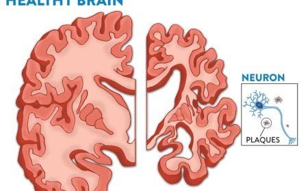 Can Alzheimer’s Be Stopped Before It Starts? Groundbreaking Trial Begins