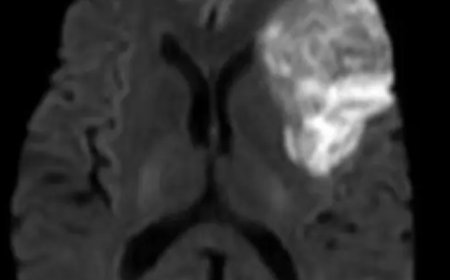 Stroke Warning: Every Minute Matters, Seek Emergency Care Immediately