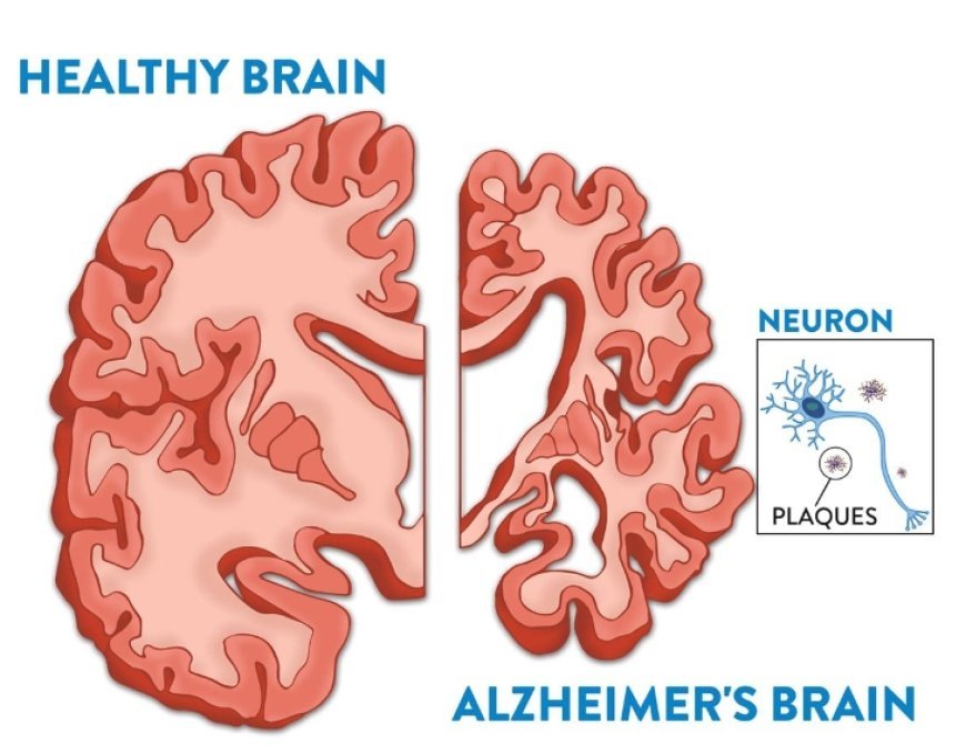 Can Alzheimer’s Be Stopped Before It Starts? Groundbreaking Trial Begins