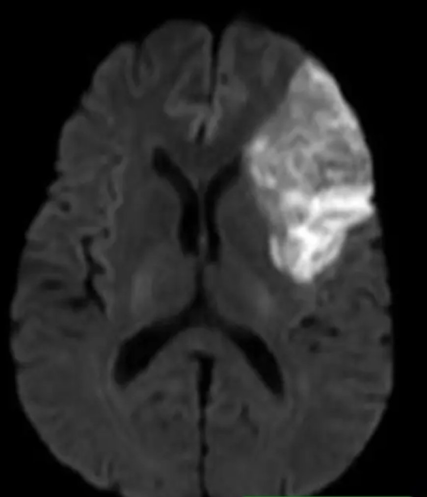 Stroke Warning: Every Minute Matters, Seek Emergency Care Immediately